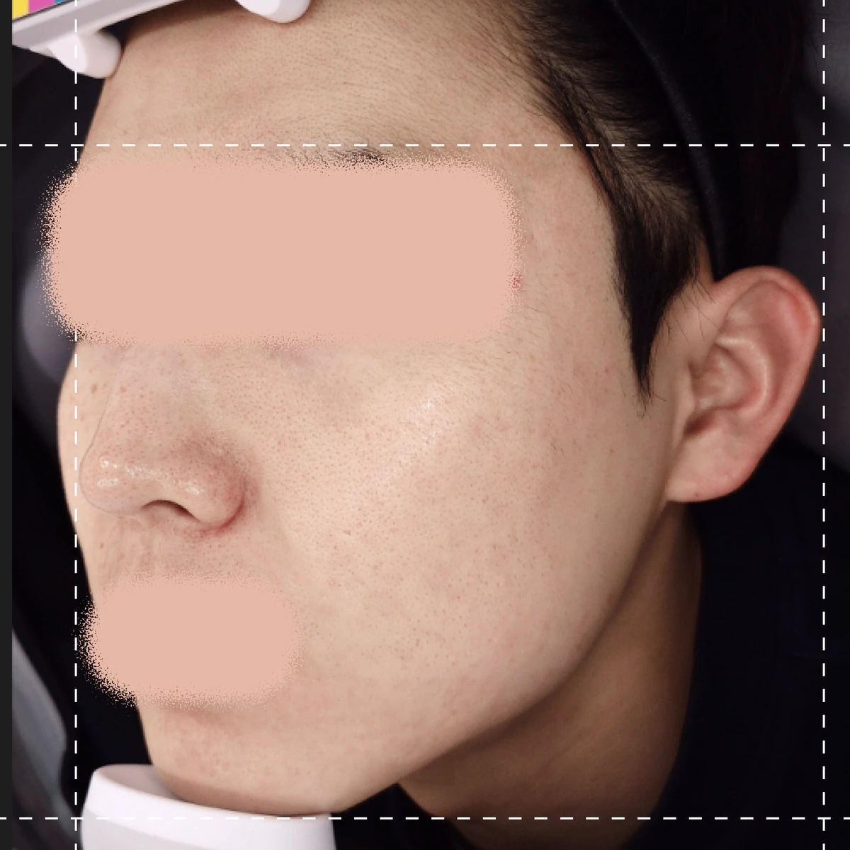 にきびセラピー施術後の写真