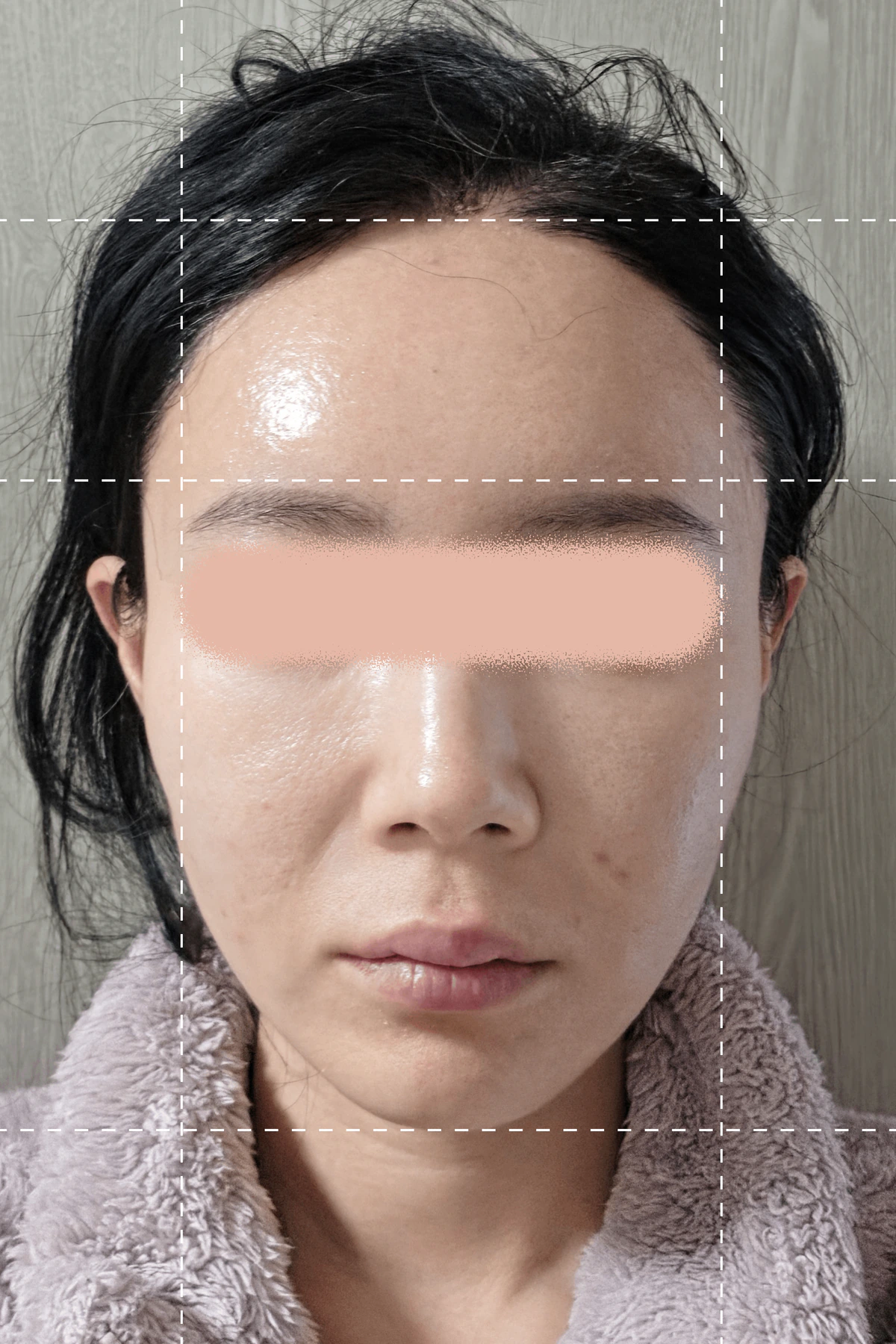 シルスカルピング施術直前の写真