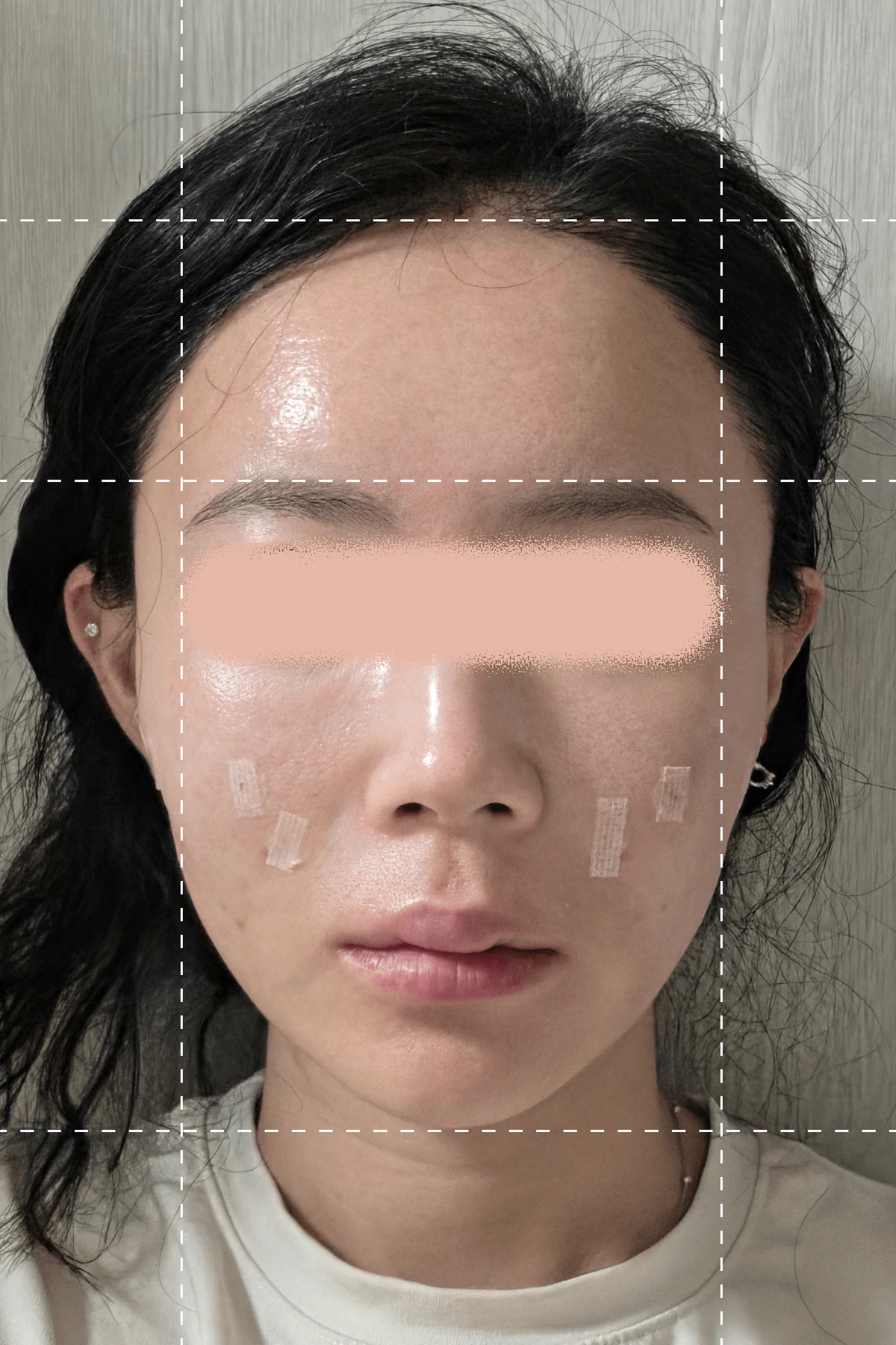 シルスカルピング施術直後の写真