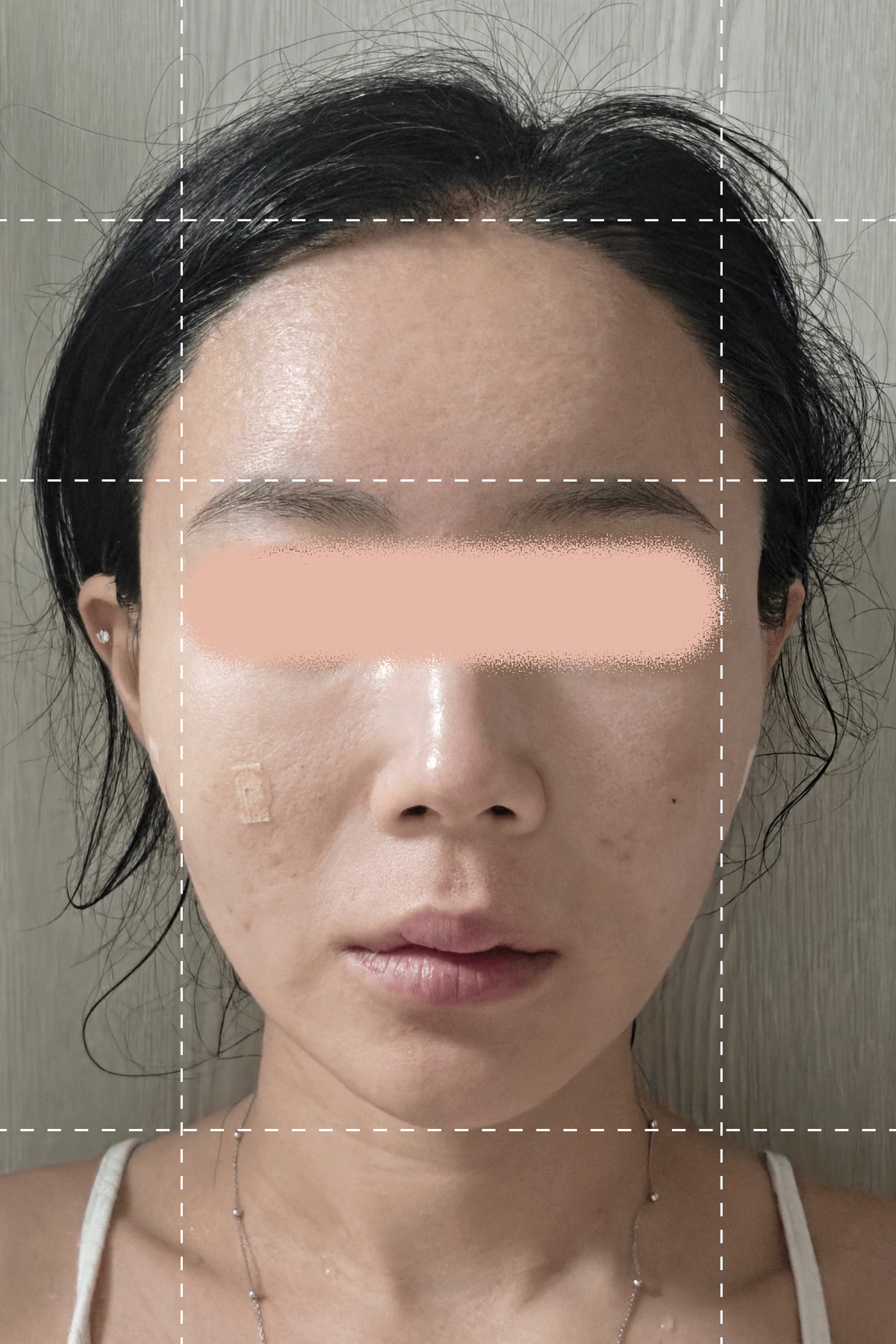 シルスカルピング施術の1週間後の写真