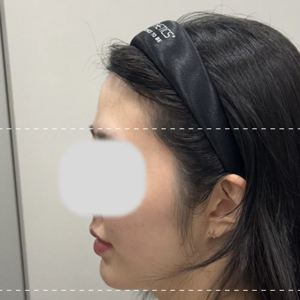 額フィラー左90度施術前