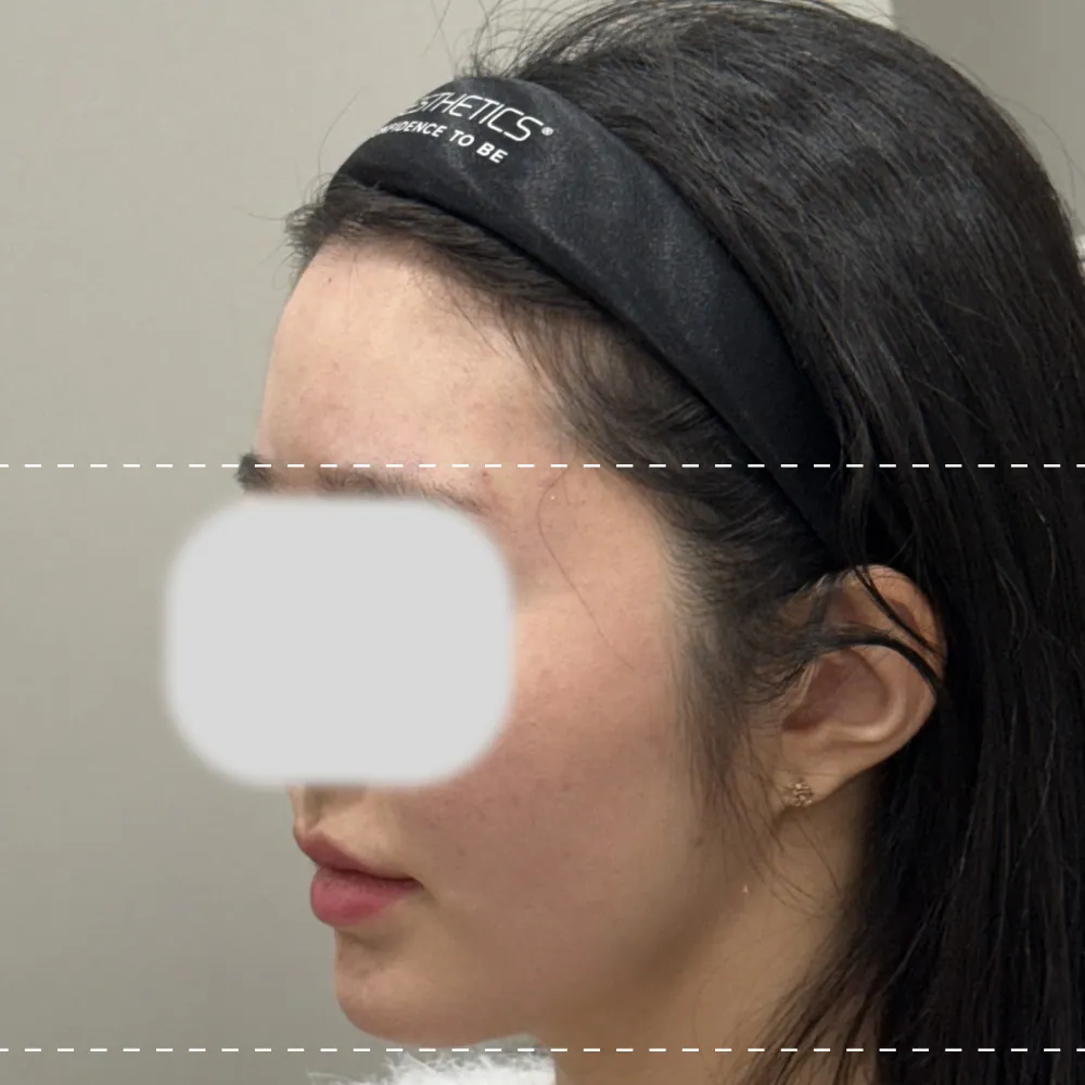 額フィラー左90度施術後
