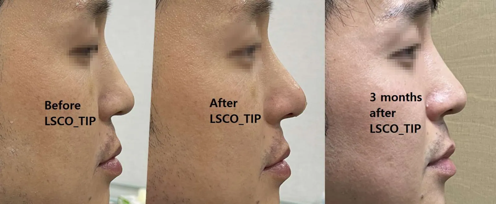 LSCO鼻先施術前、直後、3ヶ月後の横顔比較写真