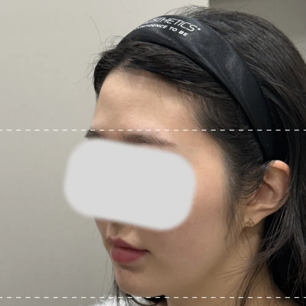 額フィラー左45度施術前