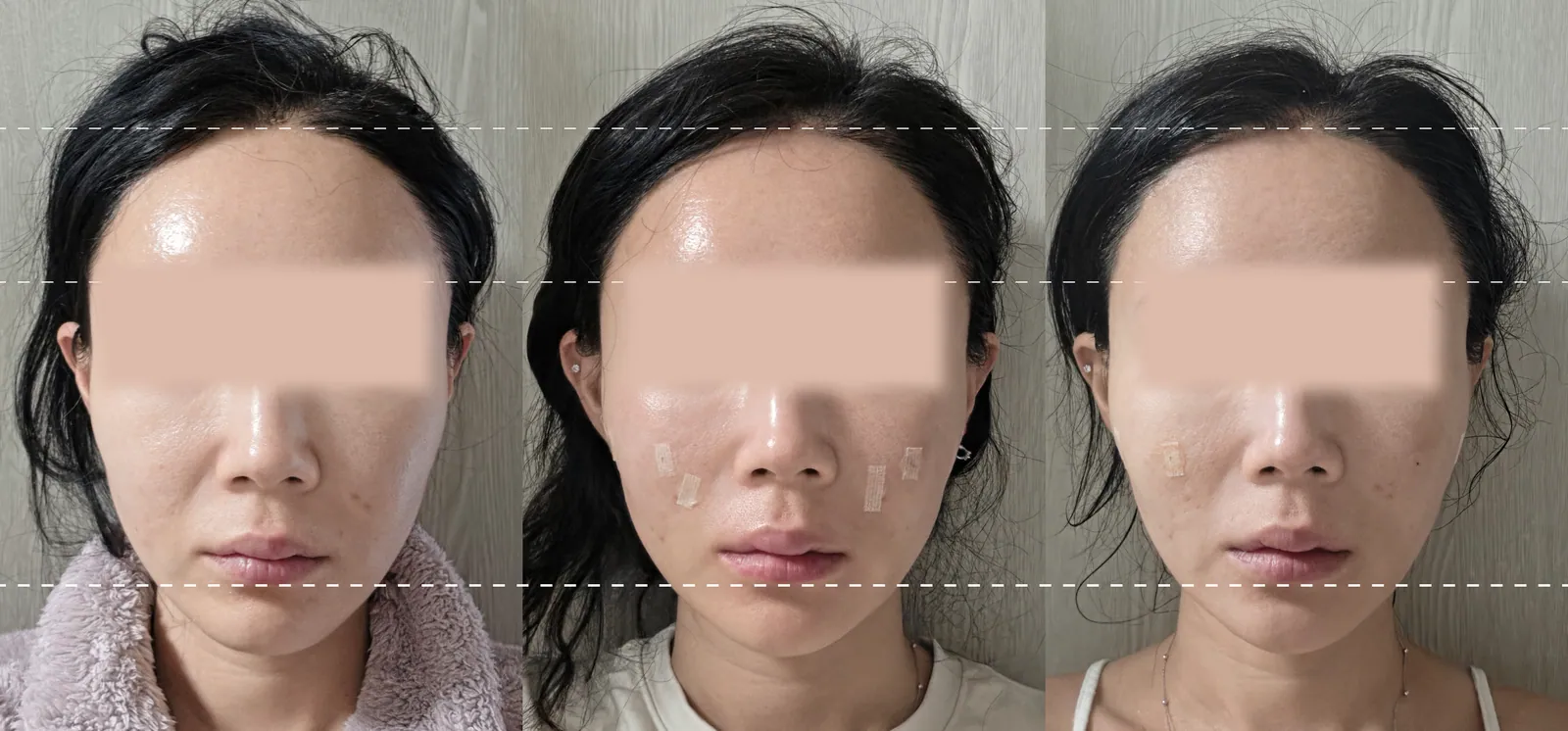 シルスカルピング前後の写真